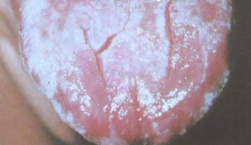艾滋病舌头毛状白斑