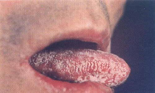 艾滋病口腔毛状白斑图图片
