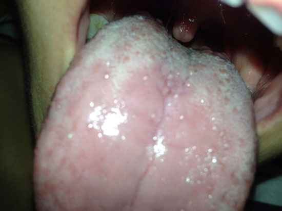 舌头根部有红疙瘩是艾滋病症状吗