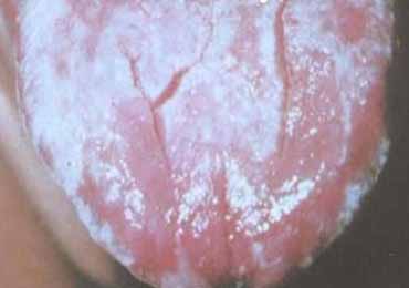 艾滋病舌头症状图片